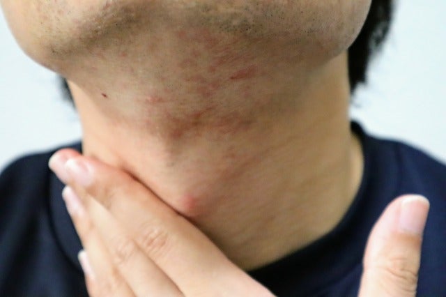 カミソリ負けしている男性の写真