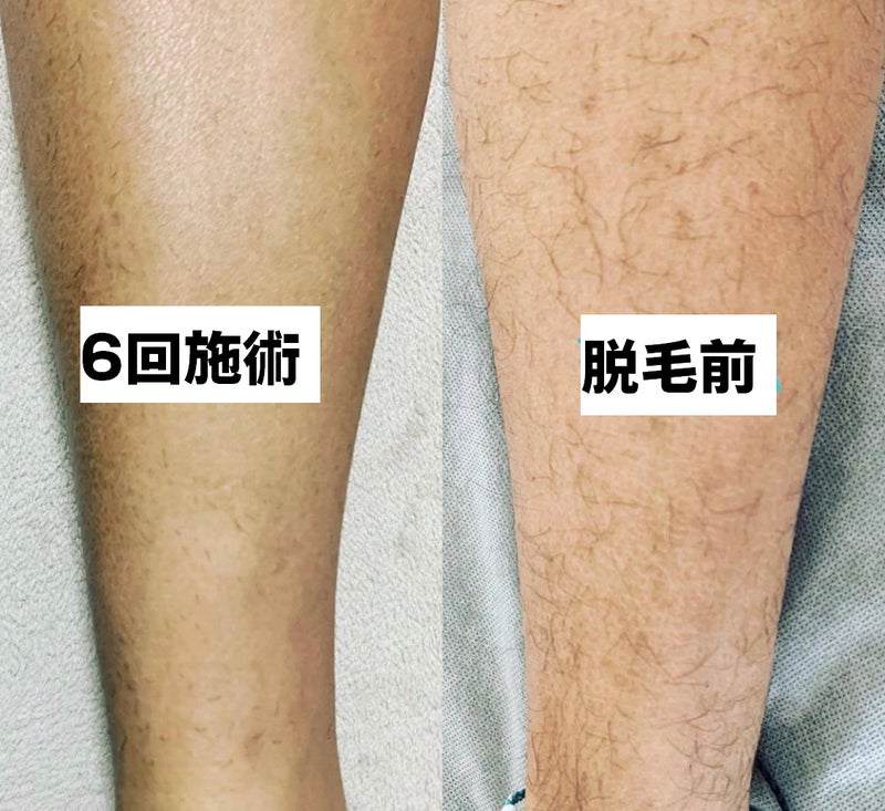 足の脱毛後の写真